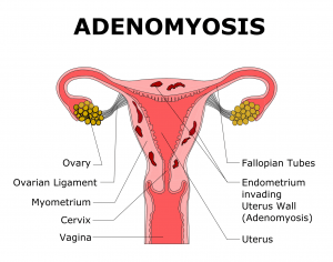 1077-767-adenomyose-1-1