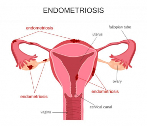 705-endometriose-1