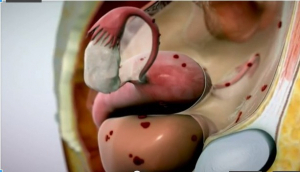 770-endometriose2-1