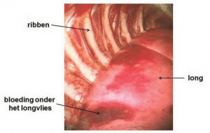 771-endometriose-longen-1