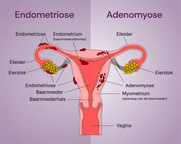 endometriose-adenomyose
