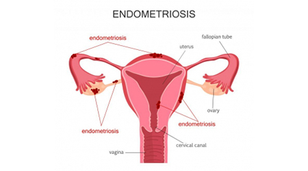 endometriose