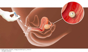 iui