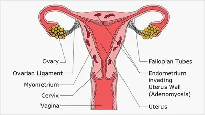what-is-adenomyosis-722x406