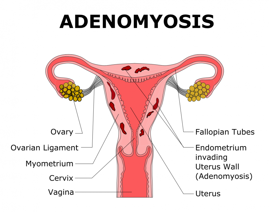 Adenomyosis What Is