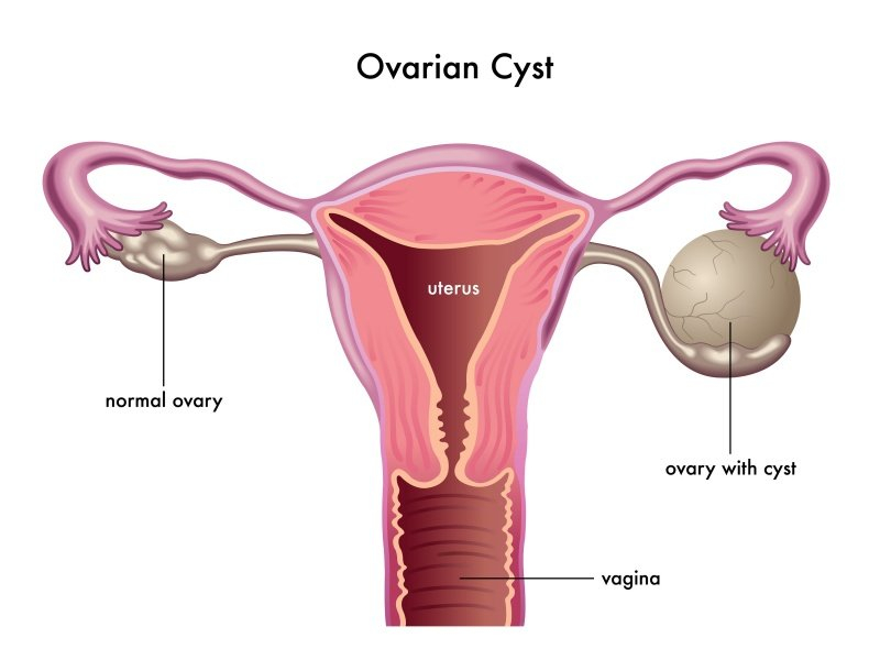 Ovariumcysten