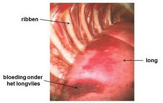 Overgang Chirurgie Verbeteren Endometriose in de borstholte · Endometriose stichting