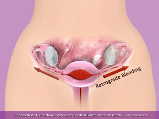 Retrograde menstruatie